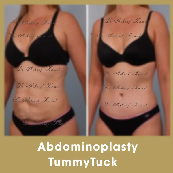 Abdominalplasty